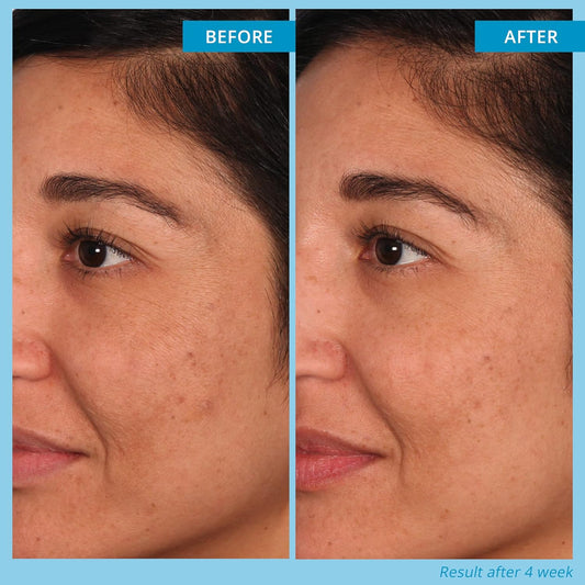 SKINN Multi-Acid Resurfacing Pads - Limited Time Offer