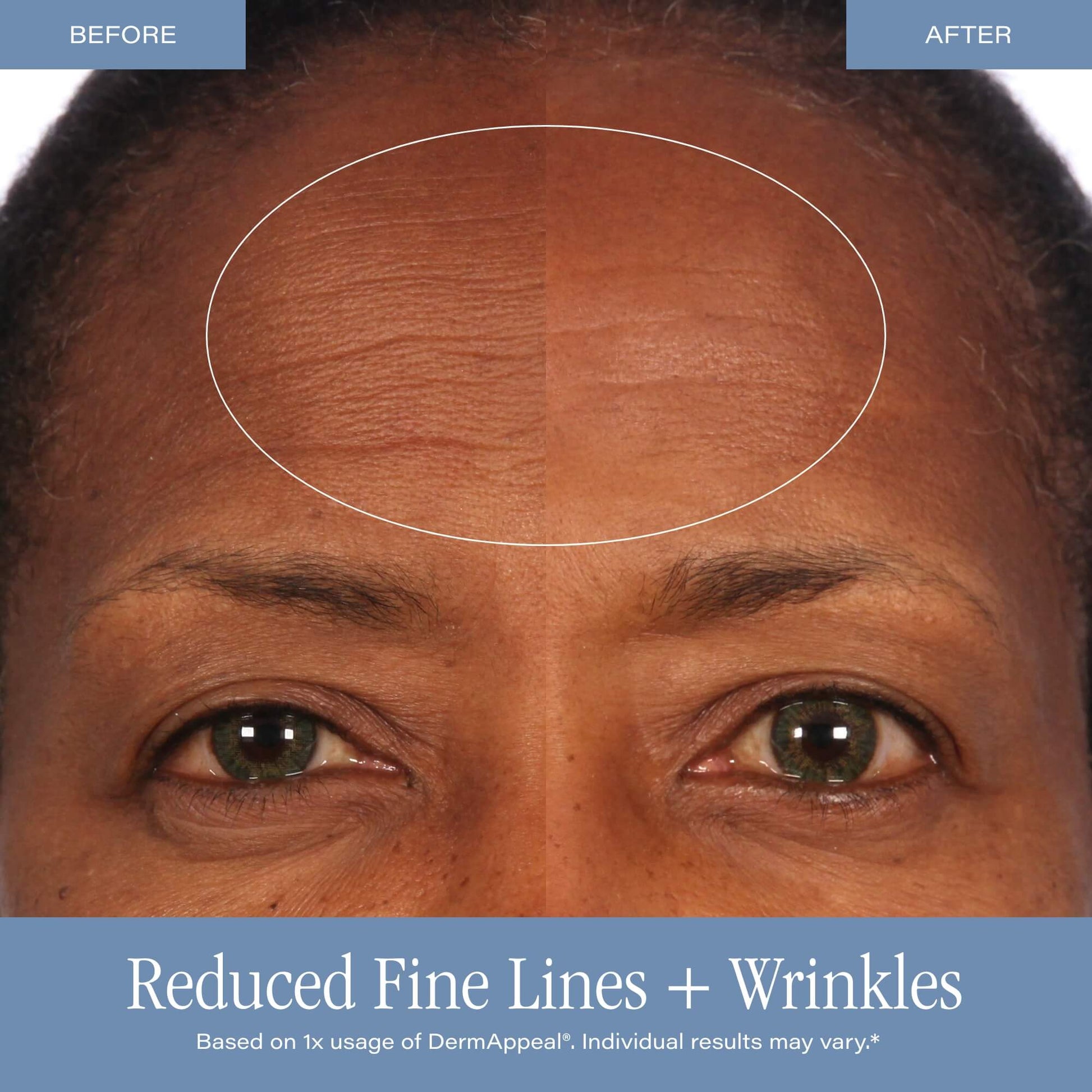 SKINN DermAppeal® Microdermabrasion Treatment